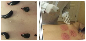 Tıbbi Sülük Tedavisinin Faydaları